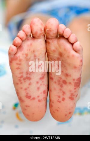 Hand foot and mouth disease a rash of painful blister and dry scaly ...