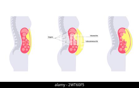 Visceral fat diagram, illustration. Belly fat surrounds internal organs ...