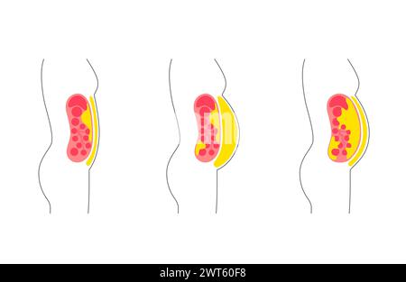 Visceral fat diagram, illustration. Belly fat surrounds internal organs ...