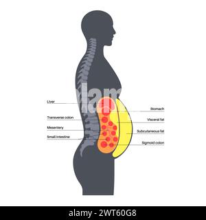 Visceral fat diagram, illustration. Belly fat surrounds internal organs ...