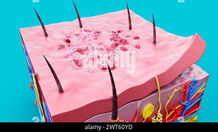 Skin lesion, illustration. Stock Photo