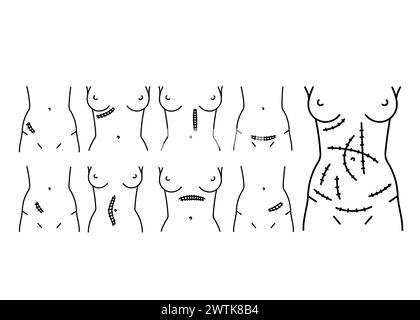 Abdominal incisions line icons set. Vector isolated element. Editable stroke. Stock Vector