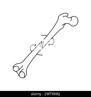 Spiral bone fracture line icon. Vector isolated element. Editable stroke. Stock Vector