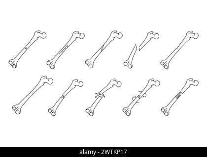 Bone fracture line icons set. Vector isolated element. Editable stroke. Stock Vector