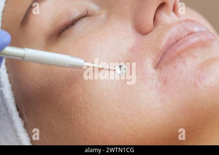 Procedure for cleaning the skin of the face with a steel appliance with a spoon from blackheads and acne. Stock Photo