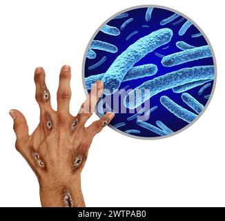 Leprosy bacterial infection Stock Photo - Alamy