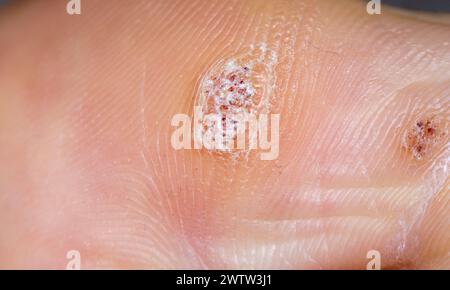 Plantar wart close up on the bottom of a big toe caused by the human papillomavirus, or HPV. Stock Photo