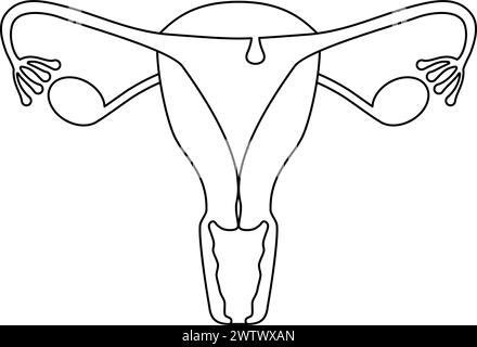 Diagrammatic illustration of endometrial polyps, anatomy of the uterus ...