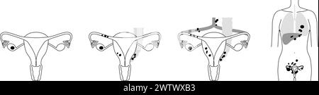 Diagrammatic illustration of stage II ovarian cancer, anatomy of the ...