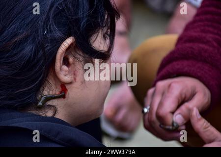 Srinagar, India. 21st Mar, 2024. A patient receives a leech therapy on ...