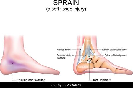 Sprain. A soft tissue injury in the human foot. Bruising and swelling of the leg skin. Close-up of a Achilles tendon, foot bones and ligaments. Torn o Stock Vector