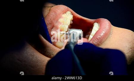 Professional dentist performing dental procedure to repair decayed tooth using drill and filling equipment in oral care clinic Stock Photo