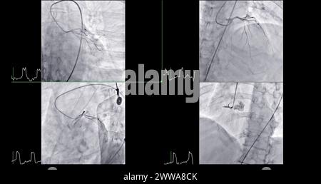 Cardiac Catheterization is a medical procedure used to examine the heart's blood vessels. Stock Photo