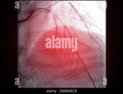 Cardiac Catheterization is a medical procedure used to examine the heart's blood vessels. Stock Photo