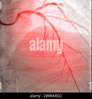 Cardiac Catheterization is a medical procedure used to examine the heart's blood vessels. Stock Photo