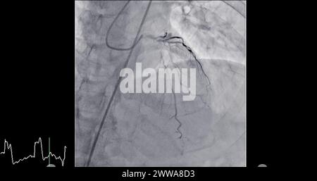 Cardiac Catheterization is a medical procedure used to examine the heart's blood vessels. Stock Photo