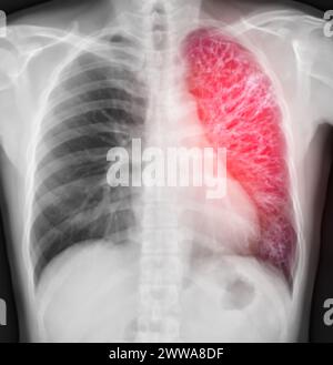 Chest X-ray Of Human Chest or Lung  fusion with CT scan 3D. Stock Photo