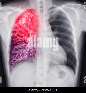 Chest X-ray Of Human Chest or Lung  fusion with CT scan 3D. Stock Photo
