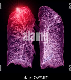 A CT chest 3D scan displaying a lesion at the right upper lobe offers a ...