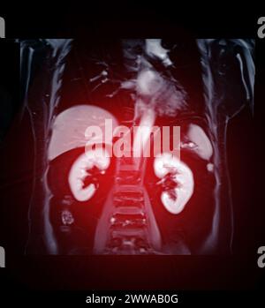 MRI of the upper abdomen coronal view is a non-invasive imaging technique providing detailed visuals of organs like the liver, pancreas, and kidneys. Stock Photo