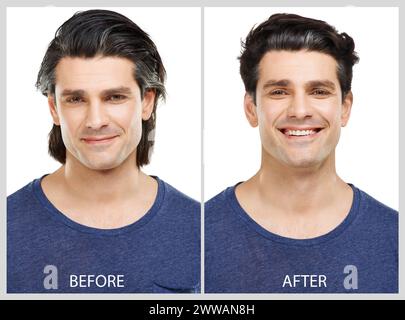 Young man with before and after treatment from acne and pimple, Before ...
