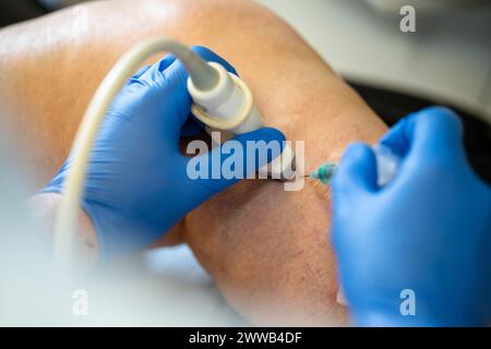Treatment of varicose veins by foam echosclerotherapy, injection into a ...