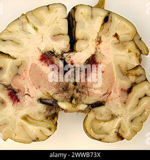 Gross specimen of brain tissue from a patient who died of granulomatous amebic encephalitis caused by Balamuthia mandrillaris. Stock Photo