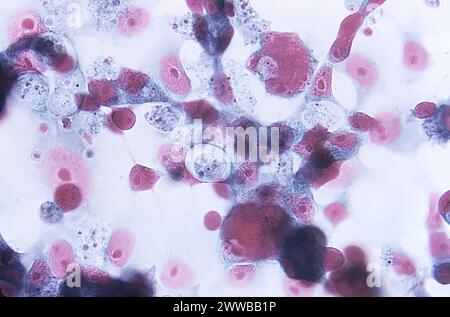 Under 500X magnification, this 1973 photomicrograph of a trichrome-stained sample of human brain tissue revealed the presence of Naegleria gruberi. Stock Photo