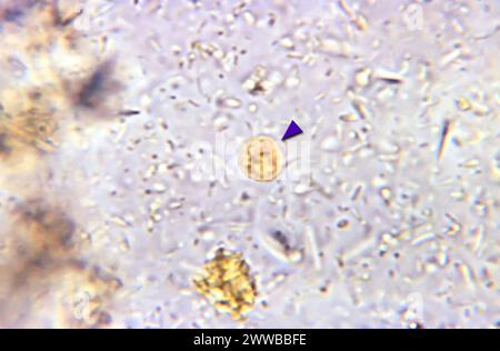 Under 1150X magnification, this photomicrograph of an iodine-stained specimen revealed the presence of an Entamoeba hartmanni cyst (arrowhead). Stock Photo