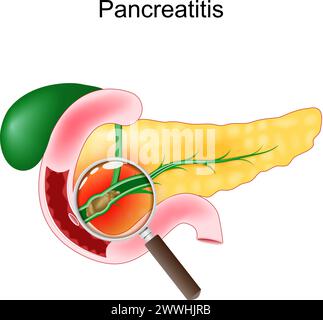 Acute pancreatitis. Close-up of a realistic pancreas, duodenum, and gallbladder. Cross section of a pancreatic duct with gallstones view through a mag Stock Vector