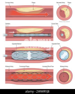 stent implantation for supporting blood circulation into blood vessels Stock Photo