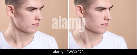 Acne problem. Young man before and after treatment on beige background, collage of photos Stock Photo