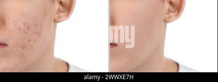 Acne problem. Young man before and after treatment on white background, closeup. Collage of photos Stock Photo