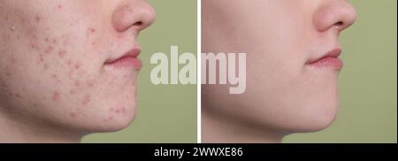 Acne problem. Young man before and after treatment on green background, closeup. Collage of photos Stock Photo