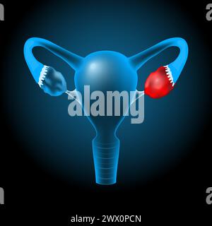 Realistic transparent blue human uterus with glowing effect on dark background. Ovarian cyst or tumor that occurs in the ovary. Vector illustration li Stock Vector