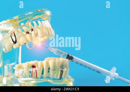 A syringe with an anesthetic anesthetic drug makes an injection into an inflamed tooth of a mock-up of a medical dental jaw on a blue background. Conc Stock Photo