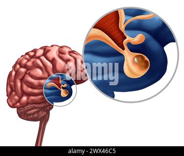 Pituitary Adenoma Benign Tumor as a noncancerous growth diagnosis on the Gland or Hypothalamus or hypophysis cerebri concept as part of the human anat Stock Photo