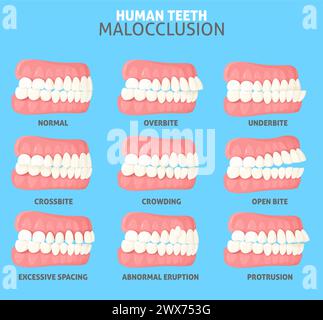 Malocclusion types side view dentist medical poster Stock Vector