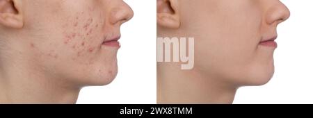 Acne problem. Young man before and after treatment on white background, closeup. Collage of photos Stock Photo