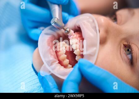 Process of polishing the teeth of a teenage girl Stock Photo