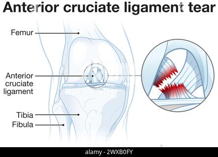 Anterior cruciate ligament tear: knee injury causing instability, pain ...