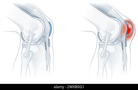 Prepatellar bursitis, inflammation of the bursa in front of the kneecap ...