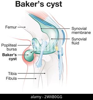 Baker's cyst: fluid-filled swelling behind the knee due to underlying knee issues, causing pain, stiffness, may require treatment. Stock Photo