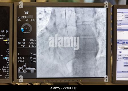 Angiogram sequence working clockwise using x-rays with a contrast agent injected from a tube inserted into the arteries (left & centre), to show the h Stock Photo