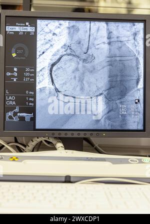 Angiogram sequence working clockwise using x-rays with a contrast agent injected from a tube inserted into the arteries (left & centre), to show the h Stock Photo