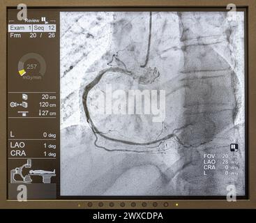 Angiogram sequence working clockwise using x-rays with a contrast agent injected from a tube inserted into the arteries (left & centre), to show the h Stock Photo