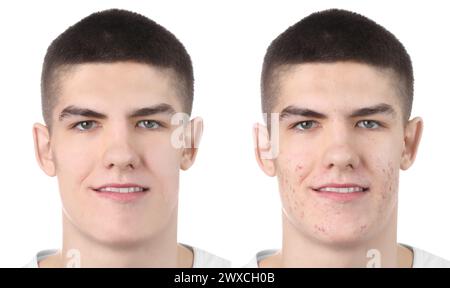 Collage with photos of young man before and after dental treatment ...