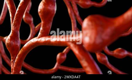 3d rendering of microaneurysms (MAs), these are small swellings of blood vessels in the retina Stock Photo