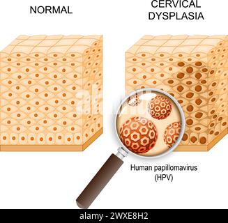 Cervical dysplasia. Close-up of Normal Squamous epithelial cells and ...