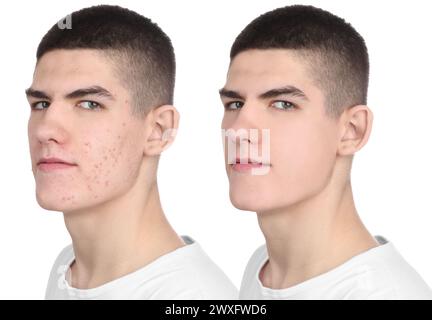 Collage with photos of young man before and after dental treatment ...